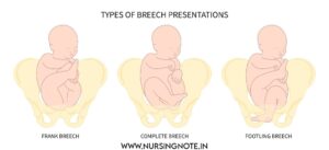 Frank Breech, Illustration of breech fetal positions: complete, incomplete, and footling breech.Complete Breech, Footling Breech, Kneeling Breech