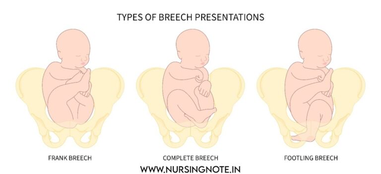 Breech Presentation: Definition,Type, Etiology and Mechanism for 3rd Year GNM A Complete Note